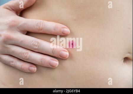 Primo piano di una verruca rimossa sull'addome di una donna. Papillomavirus umano dopo la combustione. Foto Stock