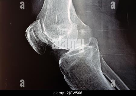 Il raggio X semplice del ginocchio destro mostra osteoartrite articolare apparente secondo il sistema di Kellgren e Lawrence per la classificazione di osteoartrite con Foto Stock