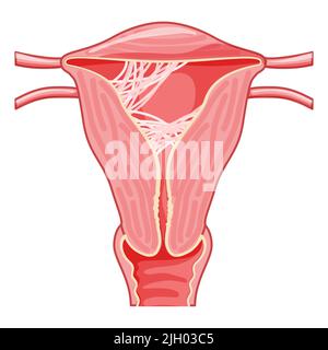 Sindrome di Asherman sistema riproduttivo femminile cicatrice tessuto adesioni in utero. Vista frontale in un taglio. Anatomia umana schema di ubicazione degli organi interni, cervice, ovaio, tubo di Falloppio icona di stile piatto Illustrazione Vettoriale