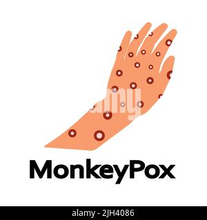 Virus Monkeypox. Eruzione sul corpo. Virus della varicella scimmia sintomi sulla mano rash infezione. Illustrazione vettoriale isolata Illustrazione Vettoriale