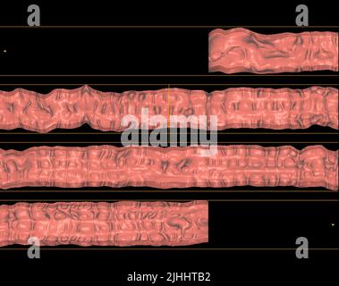 Colonografia TC o scansione TC dell'immagine di rappresentazione del colon sullo schermo per la diagnosi del cancro del colon dell'intestino crasso o del cancro colorettale. Foto Stock