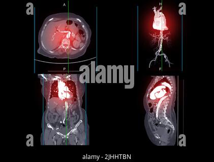 CTA intera aorta che mostra l'immagine delle arterie nell'intero corpo generate dallo scanner TC Foto Stock