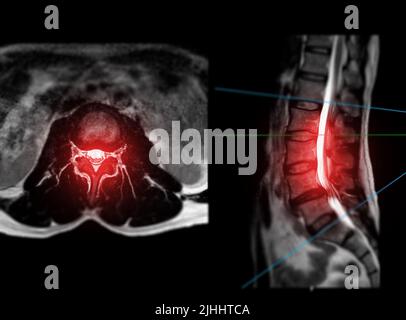 Vista MRI colonna L-S o colonna lombare assiale T2W con piano sagittale per diagnosi compressione del midollo spinale. Foto Stock