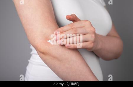 Donna che mette guarigione o dolore alleviare unguento al gomito per ridurre gonfiore e infiammazione o trattamento di irritazione della pelle. Assistenza sanitaria, concetto di dermatologia. Foto di alta qualità Foto Stock