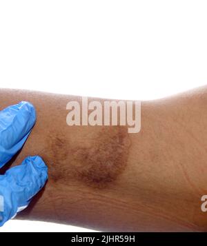 Mostra una scottatura causata da un ferro caldo durante la stiratura domestica su uno sfondo bianco, isolato Foto Stock