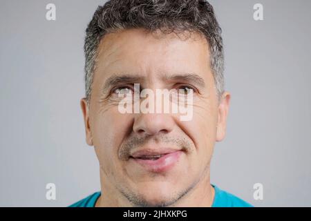 Reazione allergica sul labbro di un uomo dopo un pungiglione dell'ape Foto Stock