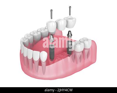 3d rappresentazione della mandibola con ponte dentale supportato da impianti in mandibola su sfondo bianco Foto Stock