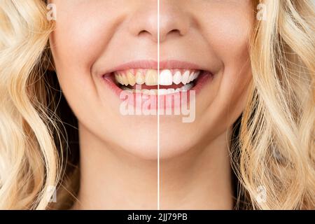 Donna sorridente prima e dopo la procedura di sbiancamento dei denti, immagine close-up. Foto Stock