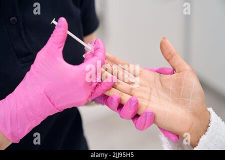 Iniezioni di tossina botulinica per sudorazione in una palma donna Foto Stock