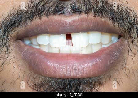 Vecchi riempimenti sui denti. 24-07-2022 Foto Stock