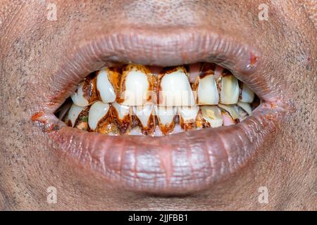 Vecchi riempimenti sui denti. 24-07-2022 Foto Stock