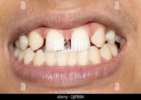 Vecchi riempimenti sui denti. 24-07-2022 Foto Stock