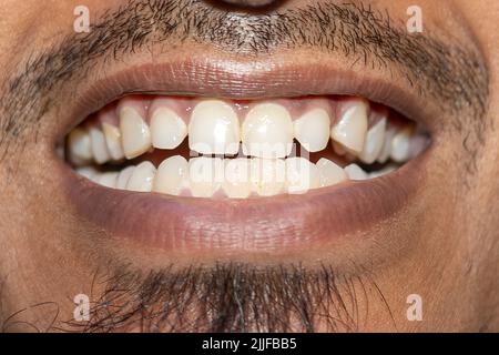 Vecchi riempimenti sui denti. 24-07-2022 Foto Stock