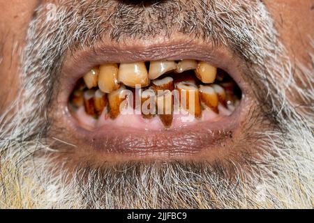 Vecchi riempimenti sui denti. 24-07-2022 Foto Stock