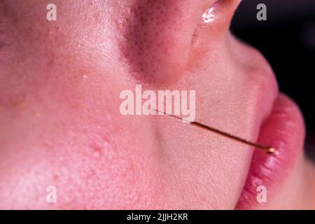 Un ritratto macro di un piccolo ago di agopuntura che si attacca nel viso di una persona vicino al naso, per alleviare lo stress, guarire il dolore o un'altra condizione medica Foto Stock