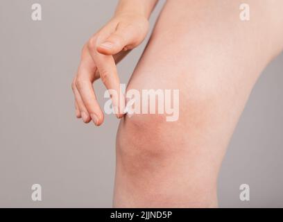 Donna che mette il dolore che allevia la crema sul ginocchio. Informazioni sulle lesioni alle gambe. Legamenti a spruzzo, lacrima menisco, tendinite. Problemi di salute, condizioni mediche. Foto di alta qualità Foto Stock