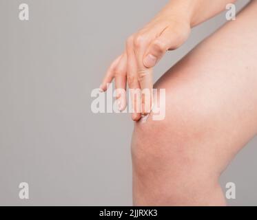 Donna che applica unguento al ginocchio per la riduzione del dolore e del gonfiore. Trattamento delle lesioni alle gambe. Lividi, sprrain, artrite, overuse. Concetto di assistenza sanitaria. Foto di alta qualità Foto Stock