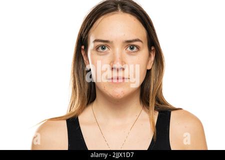 Ritratto di una bella donna senza trucco, e la pelle problematica su sfondo bianco Foto Stock