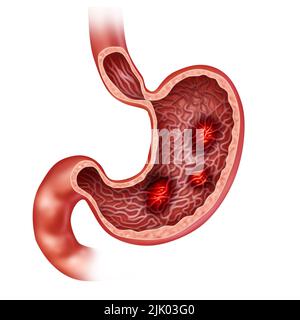 Ulcere dello stomaco e un concetto doloroso dell'ulcera con dolore di indigestione bruciante nel sistema digestivo come illustrazione medica dell'orga di digestione umana Foto Stock
