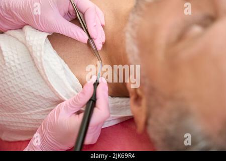 Il chirurgo dermatologo rimuove il collo dell'uomo del talpa con il metodo di scalpatura del coltello Foto Stock