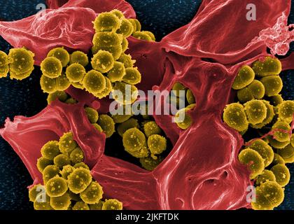 Micrografia elettronica a scansione di batteri Staphylococcus aureus resistenti alla meticillina (giallo) e di un globuli bianchi umani morti (rosso). Foto Stock