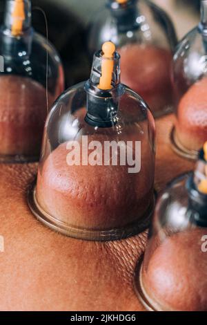 Un primo piano verticale della tecnica del massaggio a concheggiatura Foto Stock