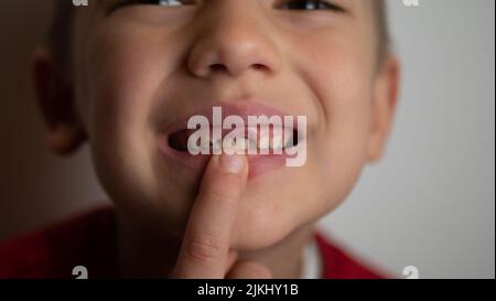 ritratto di un ragazzo con denti cattivi, denti anteriori superiori caduti Foto Stock