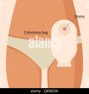 Giovane donna con sacco di colostomia. Illustrazione Vettoriale