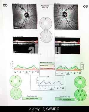 Tomografia a coerenza ottica (Oct) che mostra il nervo ottico di un paziente a rischio di glaucoma. Foto Stock