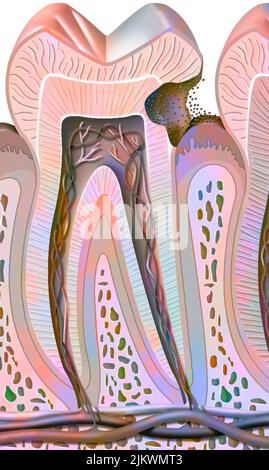 Carie dei denti del secondo stadio (danni alla dentina). Foto Stock