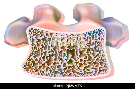 Vertebre dorsali con osteoporosi con tessuto cannelloso parzialmente distrutto. Foto Stock