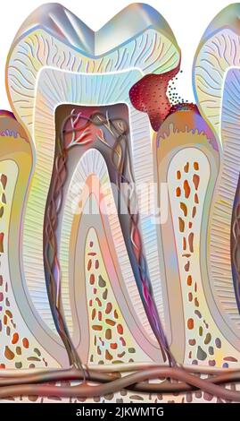 Carie dei denti del secondo stadio (danni alla dentina). Foto Stock