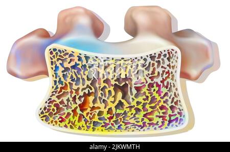 Vertebre dorsali con osteoporosi con tessuto cannelloso parzialmente distrutto. Foto Stock