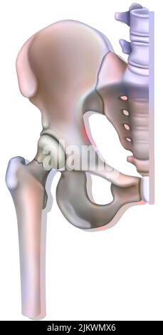 Sistema osseo: Frattura del collo del femore, legata all'osteoporosi. Foto Stock