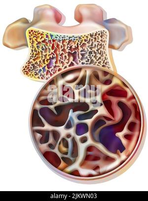 Vertebre dorsali con osteoporosi con tessuto cannelloso parzialmente distrutto. Foto Stock