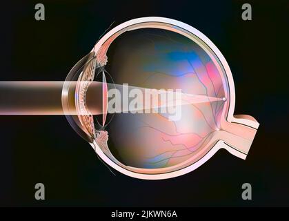 Occhio (cataratta): Impianti intraoculari nella camera anteriore e posteriore. Foto Stock
