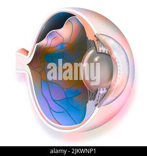 Occhio: Distacco della retina, che si stacca dal coroide sottostante. Foto Stock