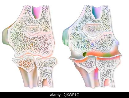 Confronto tra un gomito sano e un'artropatia emofilica (emartrosi). Foto Stock