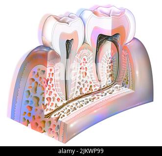 Placca dentale: Principali patologie dei denti: Tartaro, gengivite. Foto Stock
