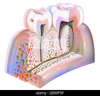 Placca dentale: Prima fase carie dentale. Foto Stock