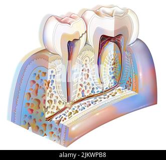 Placca dentale: Carie dentale del terzo stadio (danno alla polpa dentale). Foto Stock