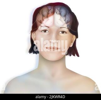 Cervello (emisferi cerebrali destro e sinistro) nel volto di una donna. Foto Stock