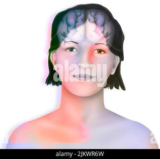 Cervello (emisferi cerebrali destro e sinistro) nel volto di una donna. Foto Stock