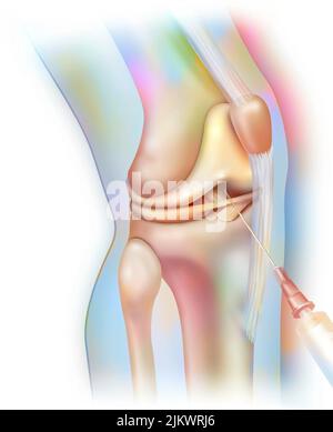 Articolazione del ginocchio, artrografia: Iniezione di prodotto di contrasto per rendere visibili le strutture sulla radio. Foto Stock
