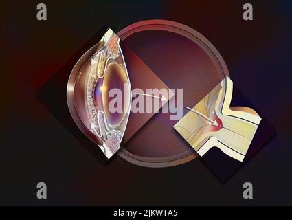 Occhio glaucomatoso con zoom di glaucoma ad angolo aperto e papilla glaucomatosa. Foto Stock