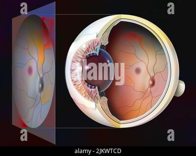 Occhio, glaucoma: Esame di un fondo con il risultato. Foto Stock