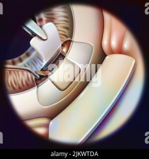 Occhio (glaucoma): Sclerectomia con rimozione di una piccola parte del trabeculum. Foto Stock