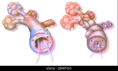 Asma: Bronchiolo sano (a sinistra) e asmatico (a destra). Foto Stock