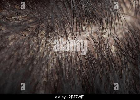 Macro colpo di forfora sul cuoio capelluto di un uomo. Problema di caduta dei capelli, cuoio capelluto pruriginoso, fungo sul cuoio capelluto, dermatite seborroica Foto Stock