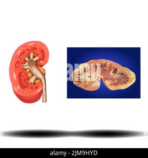 Rene - organo interno, calcoli renali. Calcoli renali, nefrolitiasi o urolitiasi. Concetto di assistenza sanitaria, illustrazione vettoriale su sfondo bianco Foto Stock